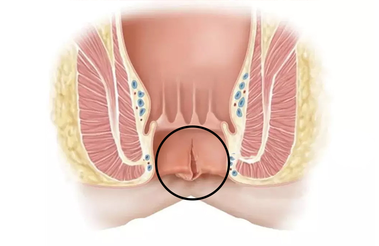Anal Fissure
