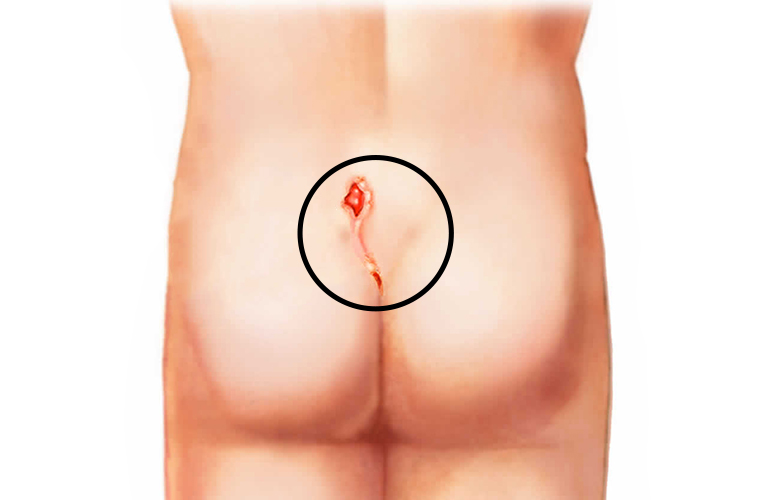 Pilonidal Sinus